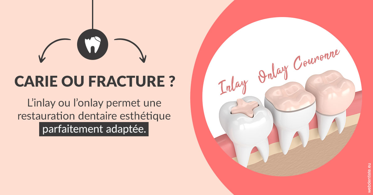 https://dr-galet-francois.chirurgiens-dentistes.fr/T2 2023 - Carie ou fracture 2
