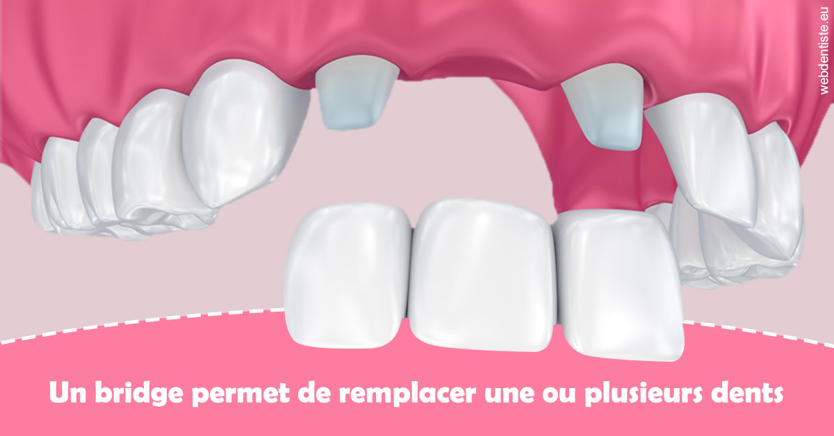 https://dr-galet-francois.chirurgiens-dentistes.fr/Bridge remplacer dents 2