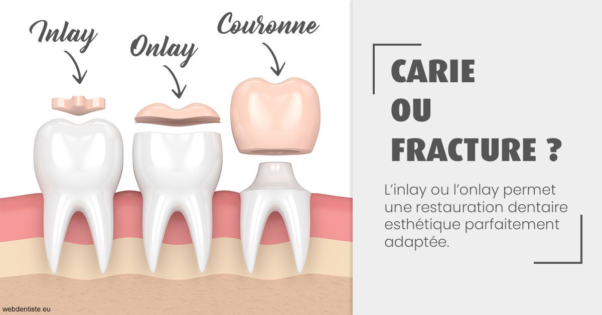 https://dr-galet-francois.chirurgiens-dentistes.fr/T2 2023 - Carie ou fracture 1