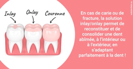 https://dr-galet-francois.chirurgiens-dentistes.fr/L'INLAY ou l'ONLAY 2