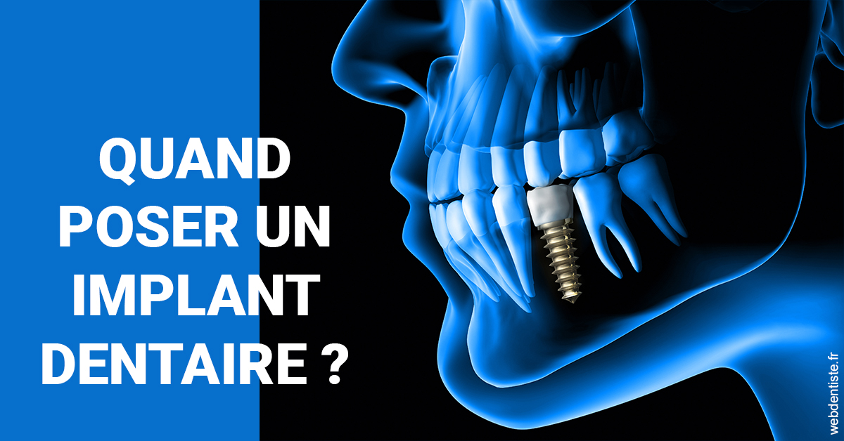 https://dr-galet-francois.chirurgiens-dentistes.fr/Les implants 1