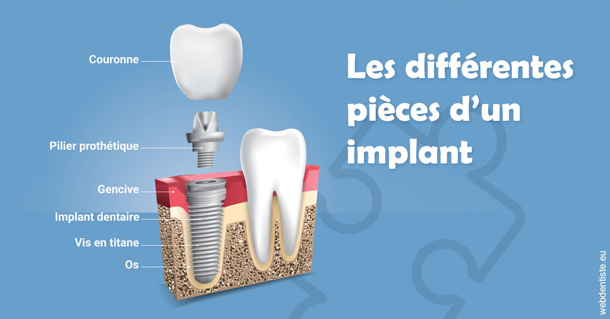 https://dr-galet-francois.chirurgiens-dentistes.fr/Les différentes pièces d’un implant 1