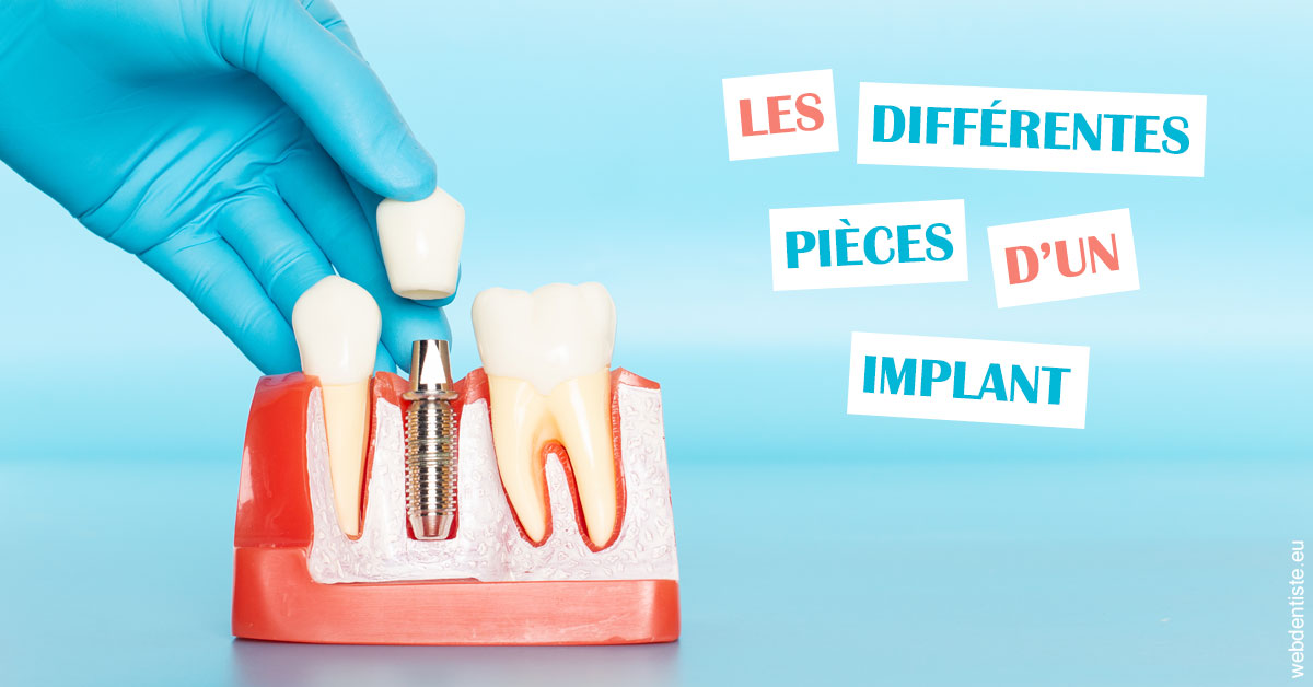 https://dr-galet-francois.chirurgiens-dentistes.fr/Les différentes pièces d’un implant 2